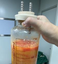新野水动力吸脂手术要做多久？